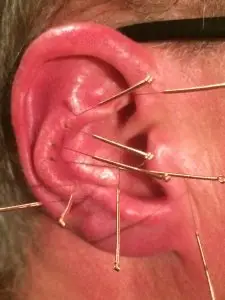 Ohrakupunktur nach Nogier